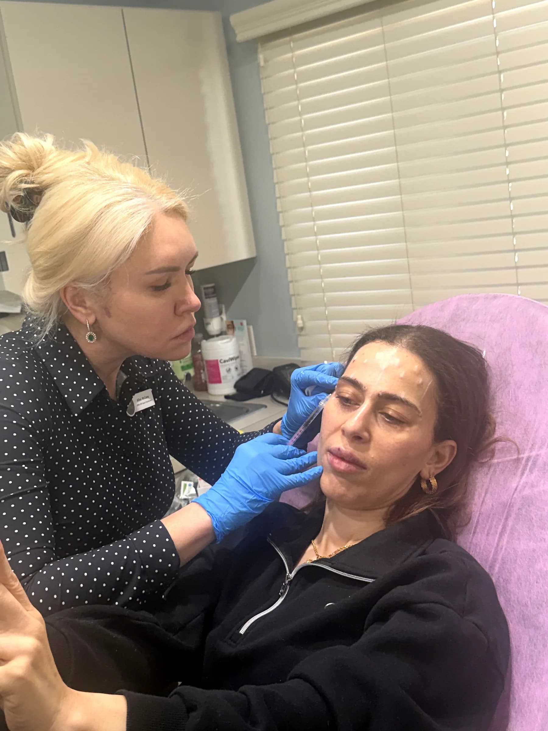 Botox placed above the upper lip for a gummy smile