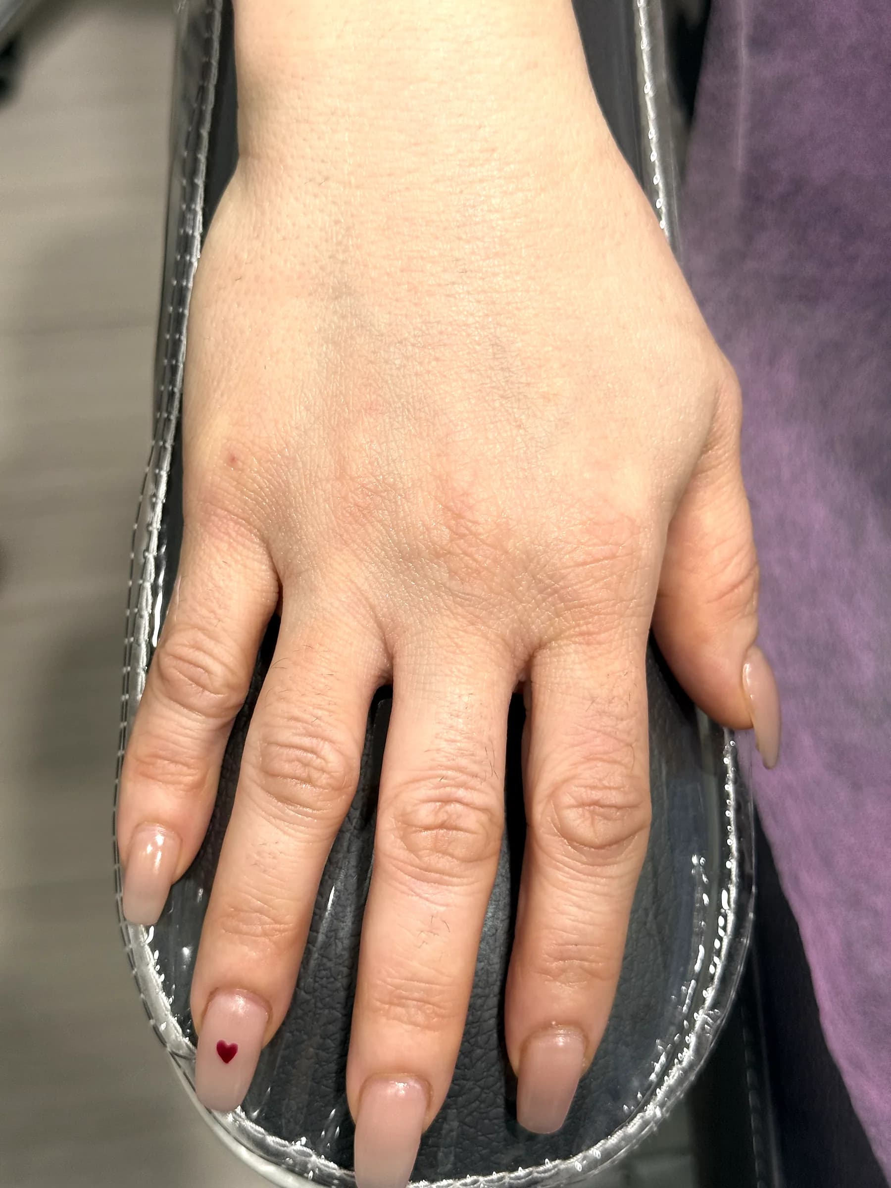 A patient's hand before hand rejuvenation