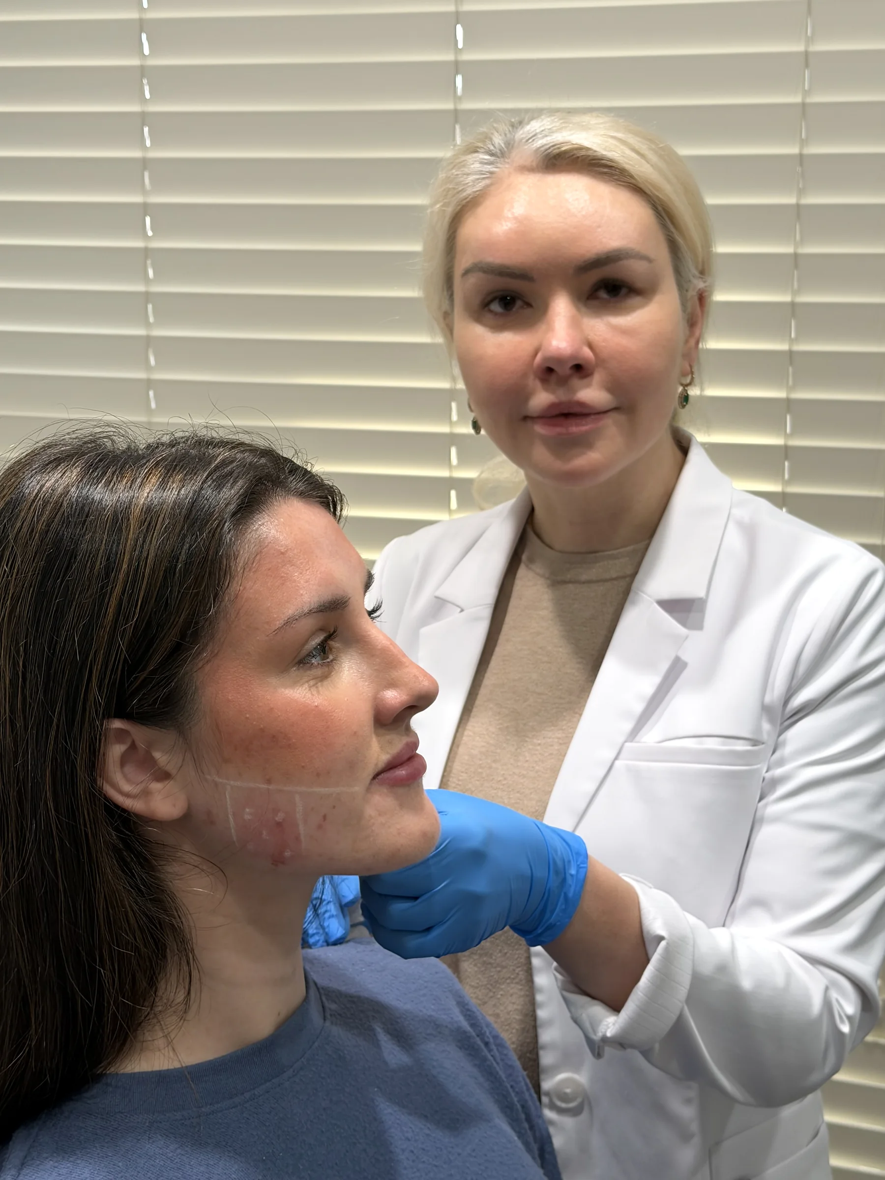 Assessing the nasolabial folds before filler