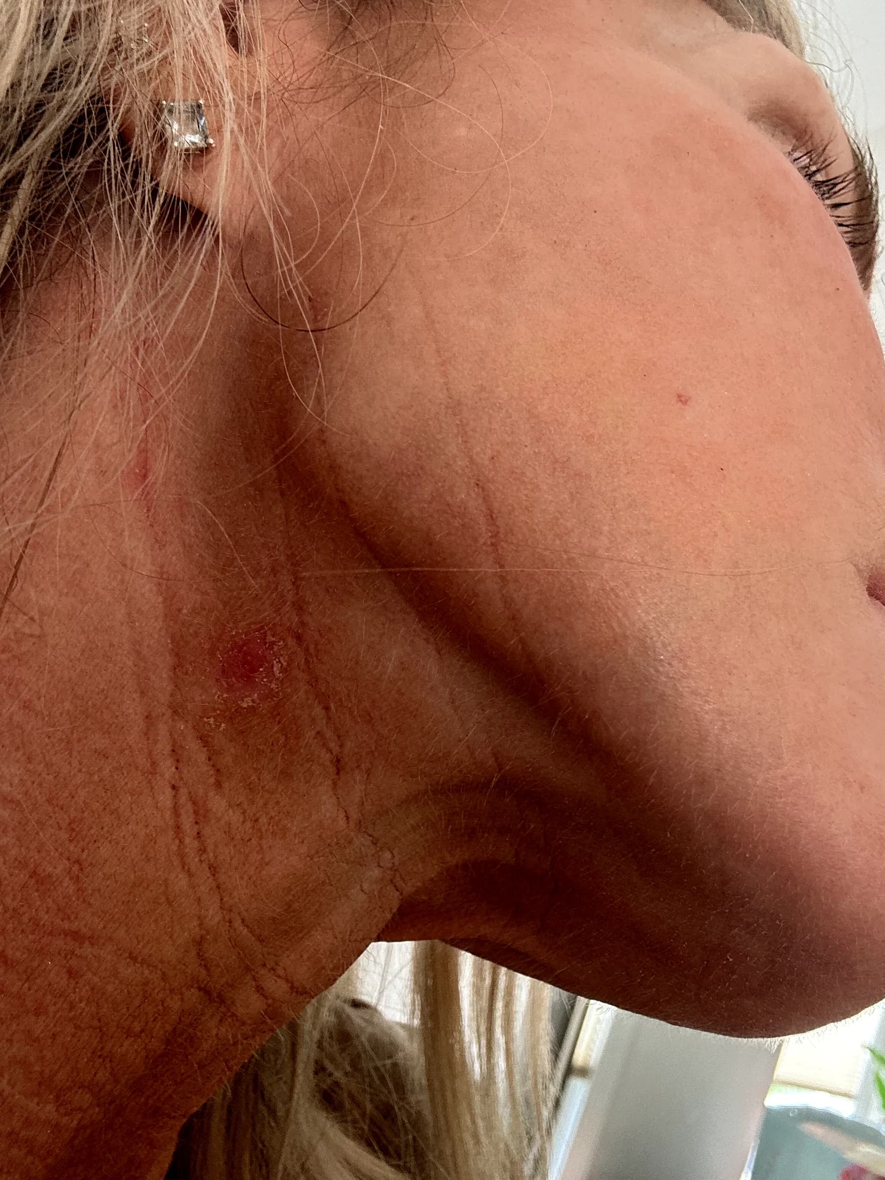 A small skin tag on the neck before removal