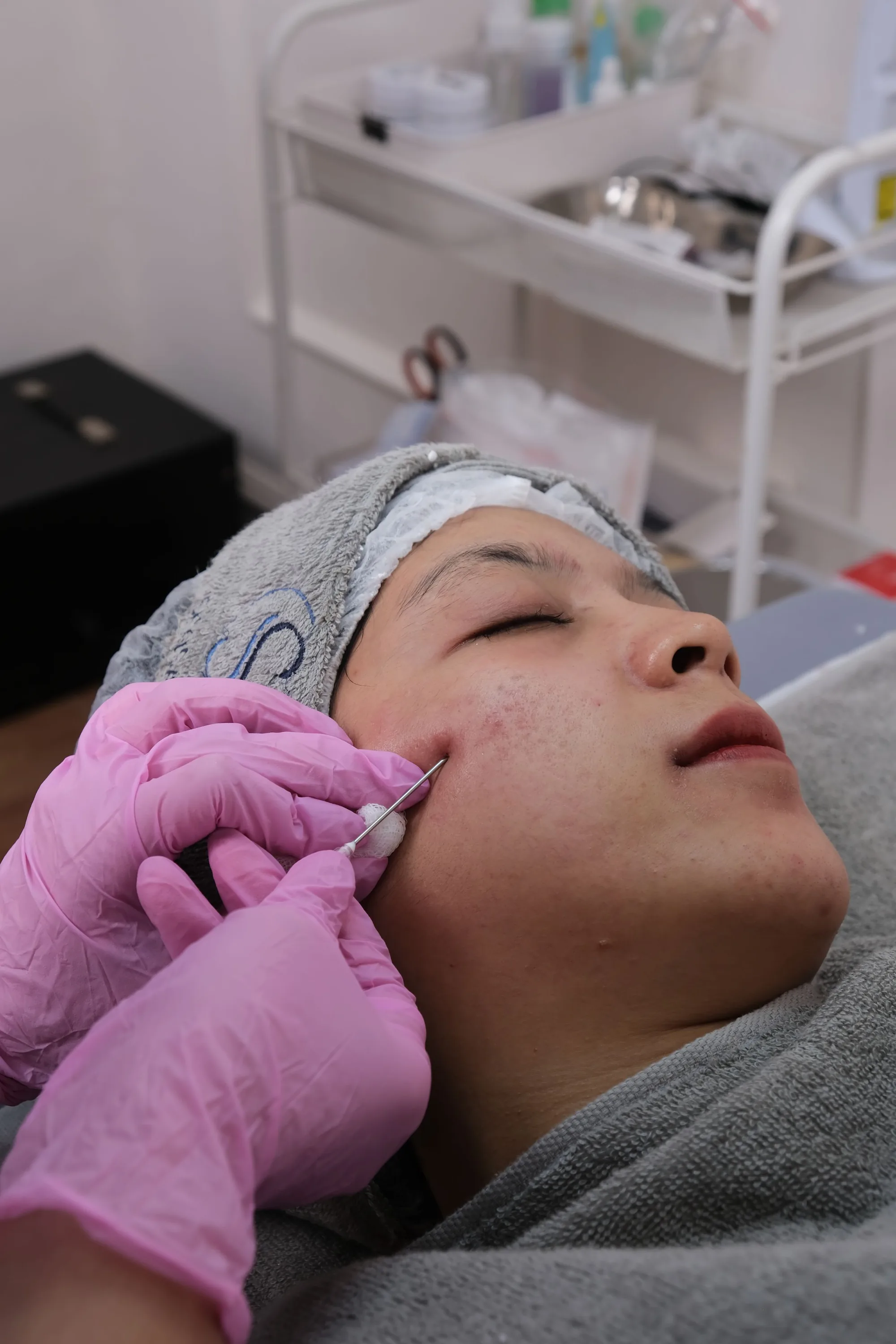 Close-up of a person undergoing microneedling skincare treatment indoors.
