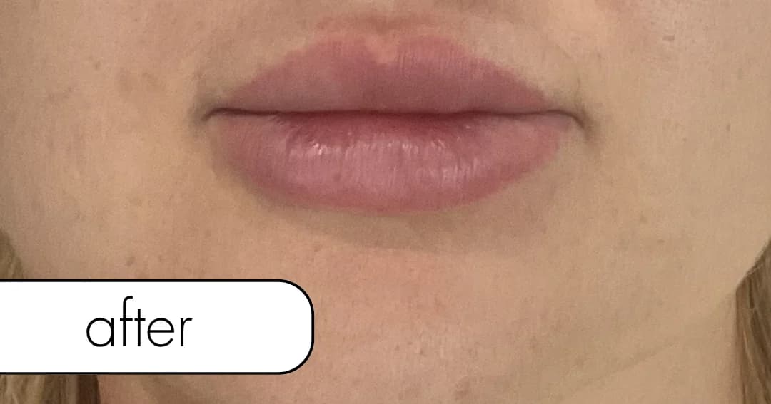 Lip filler, profile. After.