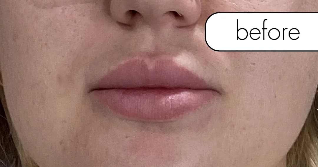 Lip filler, profile. Before.