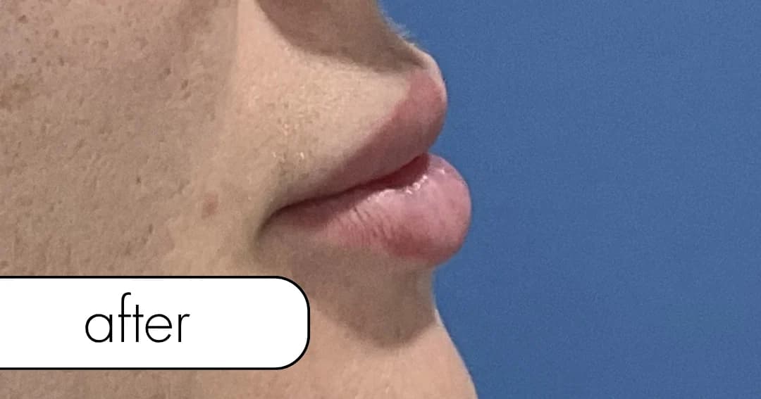Lip filler, front view. After.