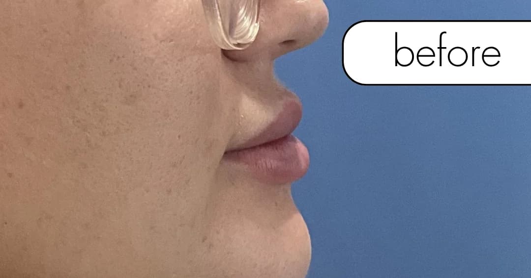 Lip filler, front view. Before.