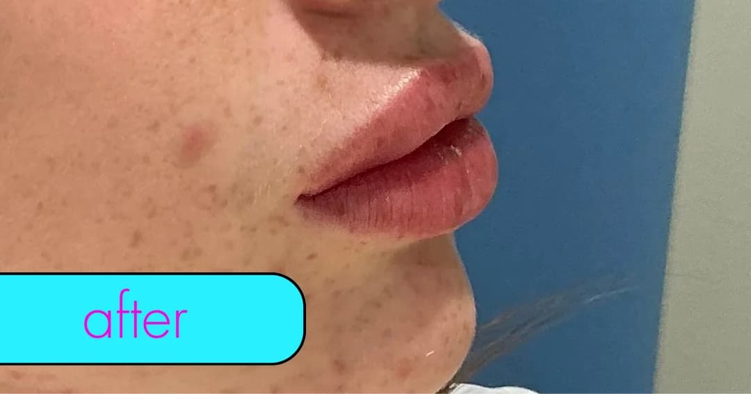Lip filler, profile. After.