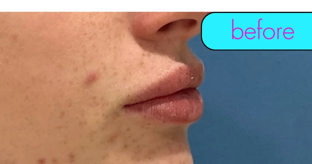 Lip filler, profile. Before.