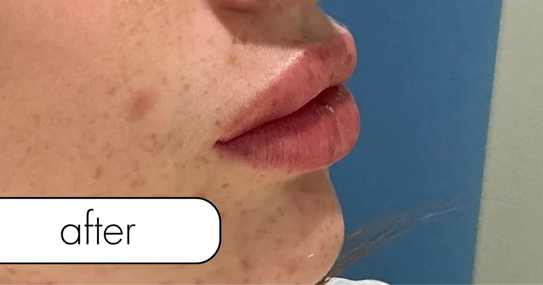 Lip filler, profile. After.