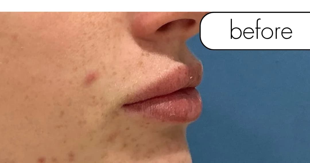 Lip filler, profile. Before.