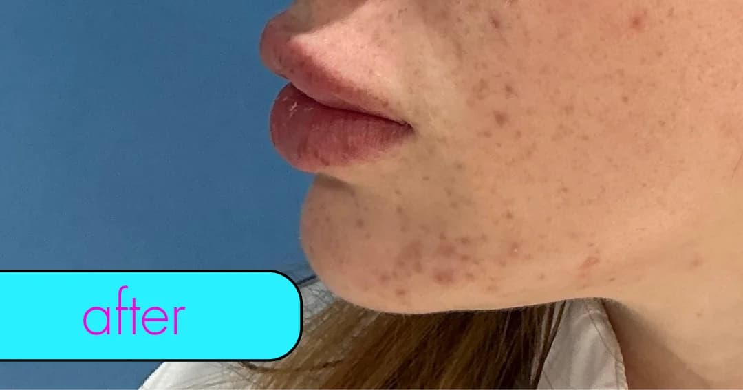 Lip filler, profile. After.