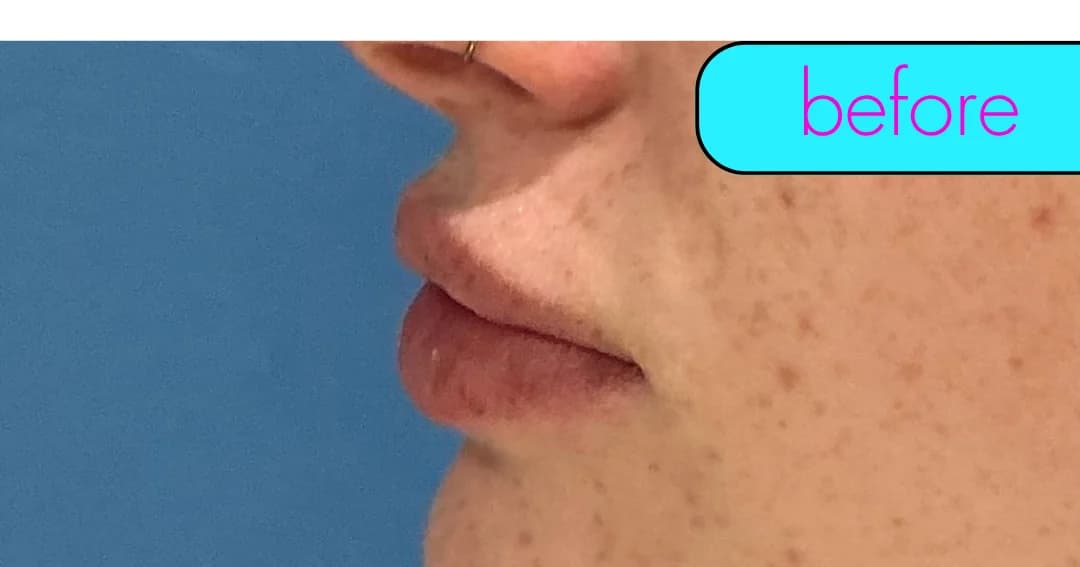 Lip filler, profile. Before.
