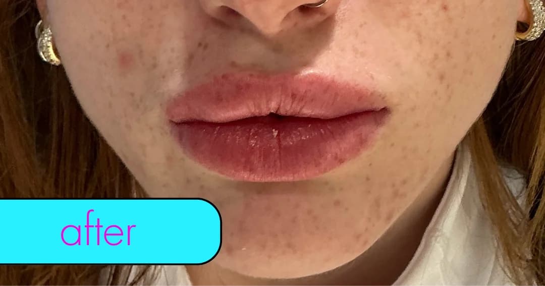 Lip filler, profile. After.