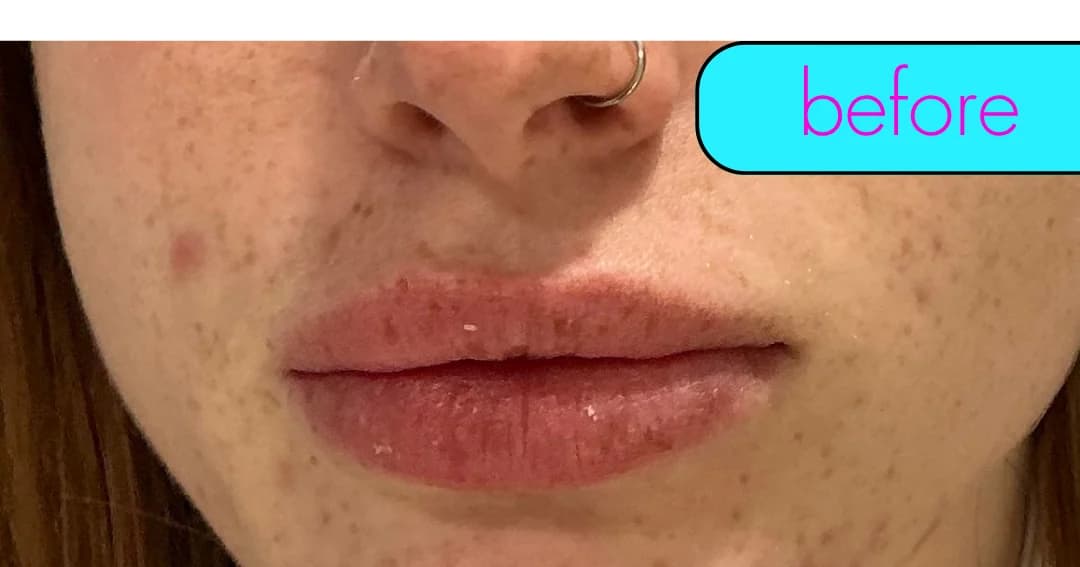 Lip filler, profile. Before.