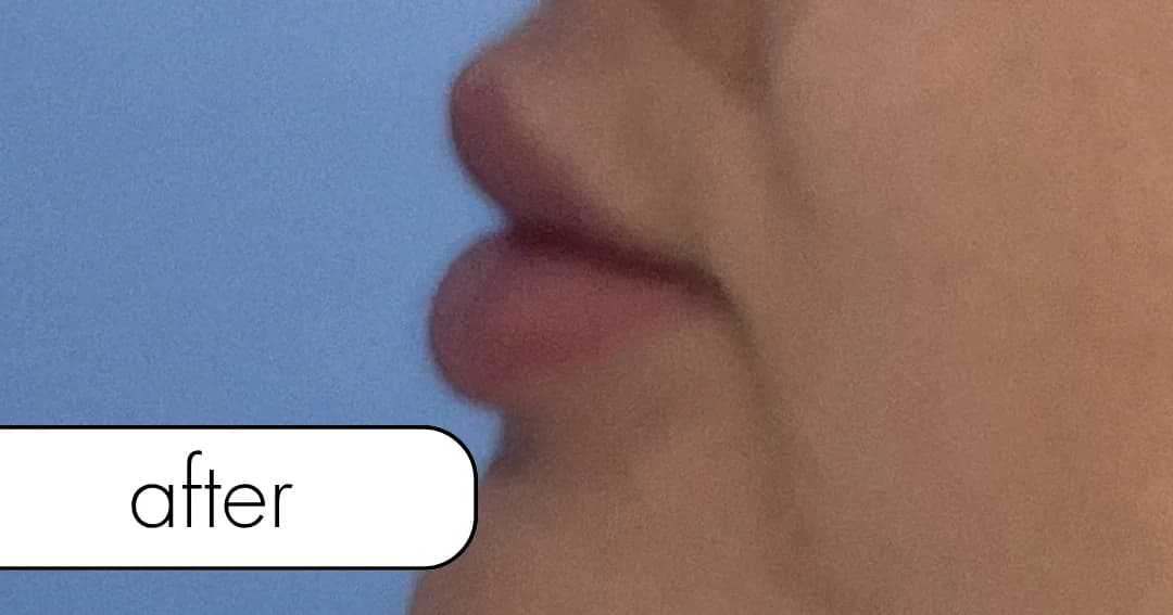 Lip filler, front view. After.