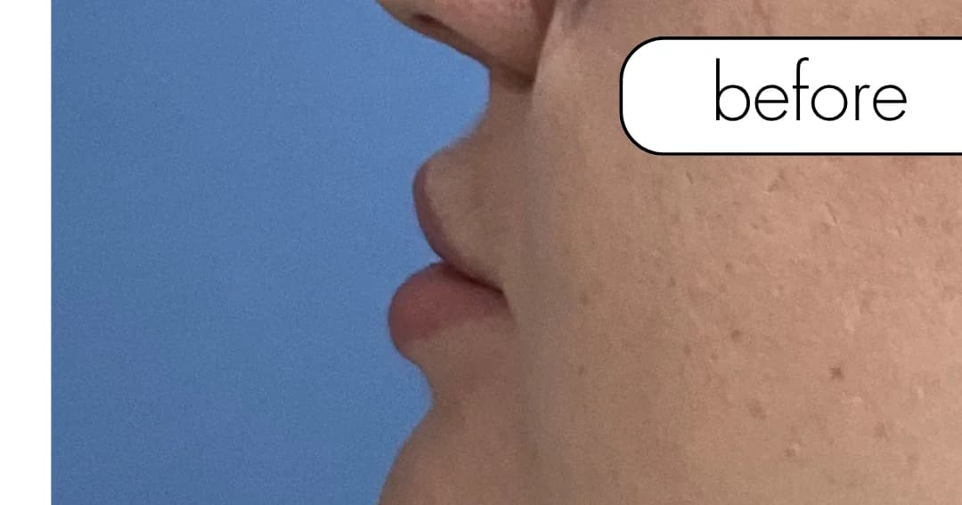 Lip filler, front view. Before.