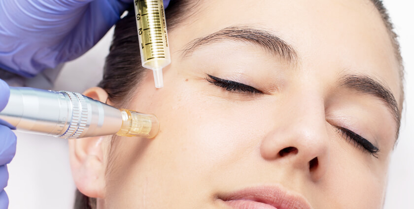 Microneedling, Mesotherapy​, medical spa in creve coeur