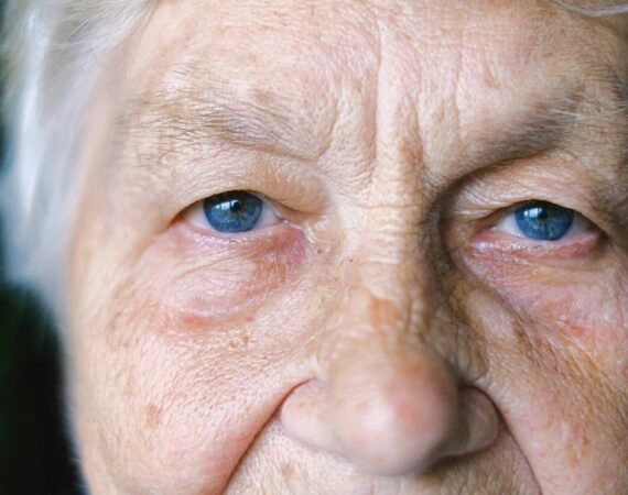 Wrinkle Relaxers in st louis