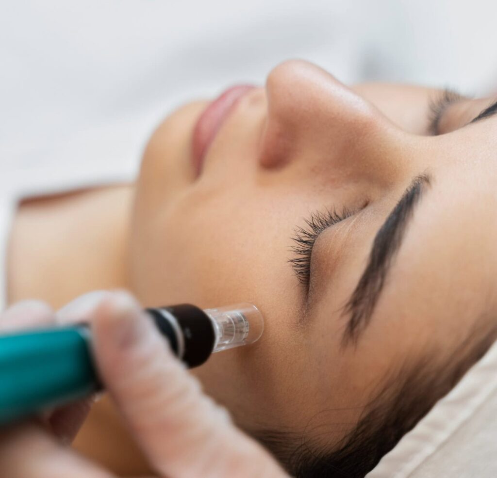 mesotherapy-and-Microneedling-in-creve-coeur