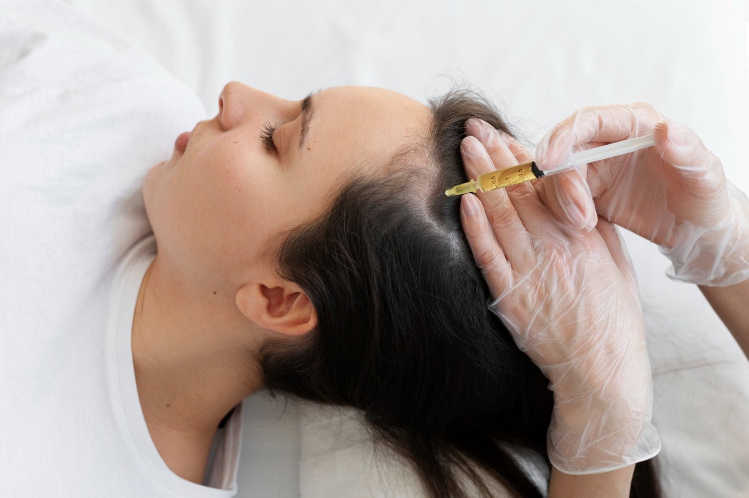 Person receiving Platelet Rich Plasma (PRP) treatment for hair restoration, with a syringe applying PRP to the scalp, promoting hair growth and health.