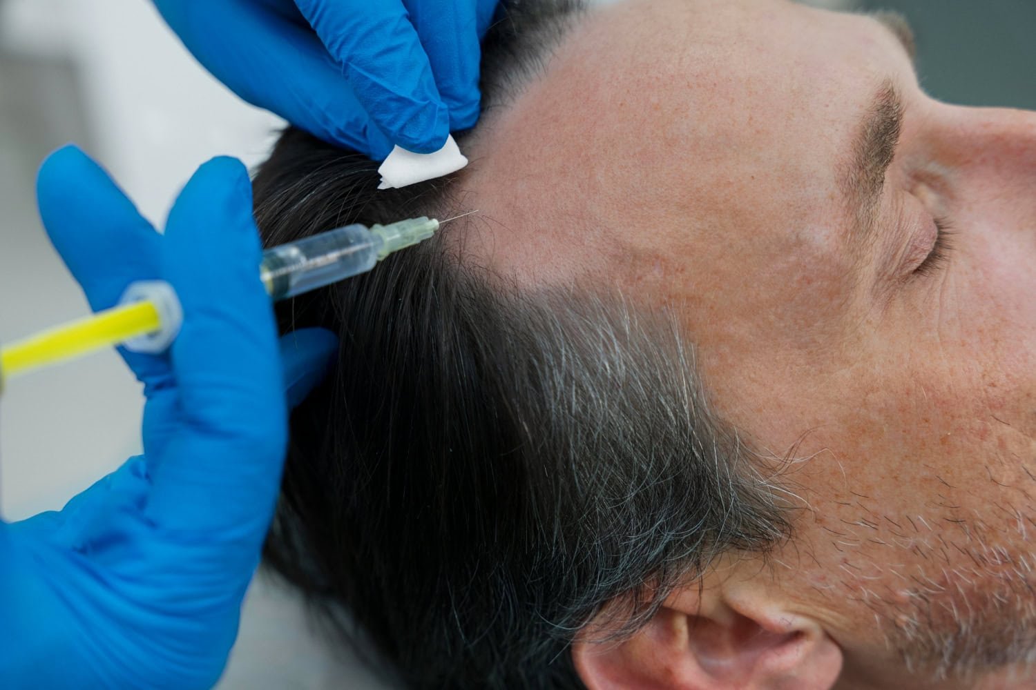 Medical professional administering Platelet Rich Plasma (PRP) injection to scalp of man for hair restoration therapy, promoting natural hair regrowth and thickness.