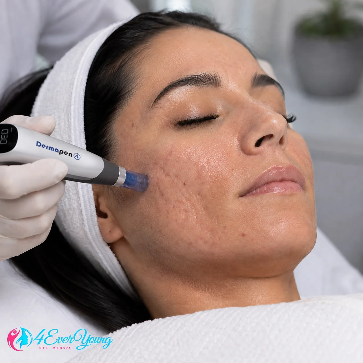 Microneedling for Acne Scars