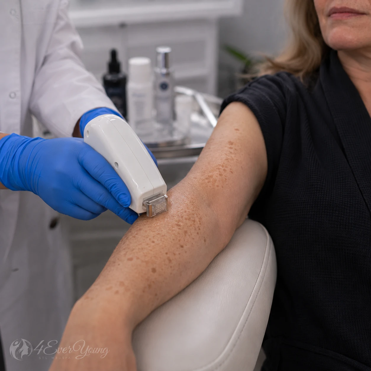 Skin Micro Infusion for Pigmentation Creve Coeur MO