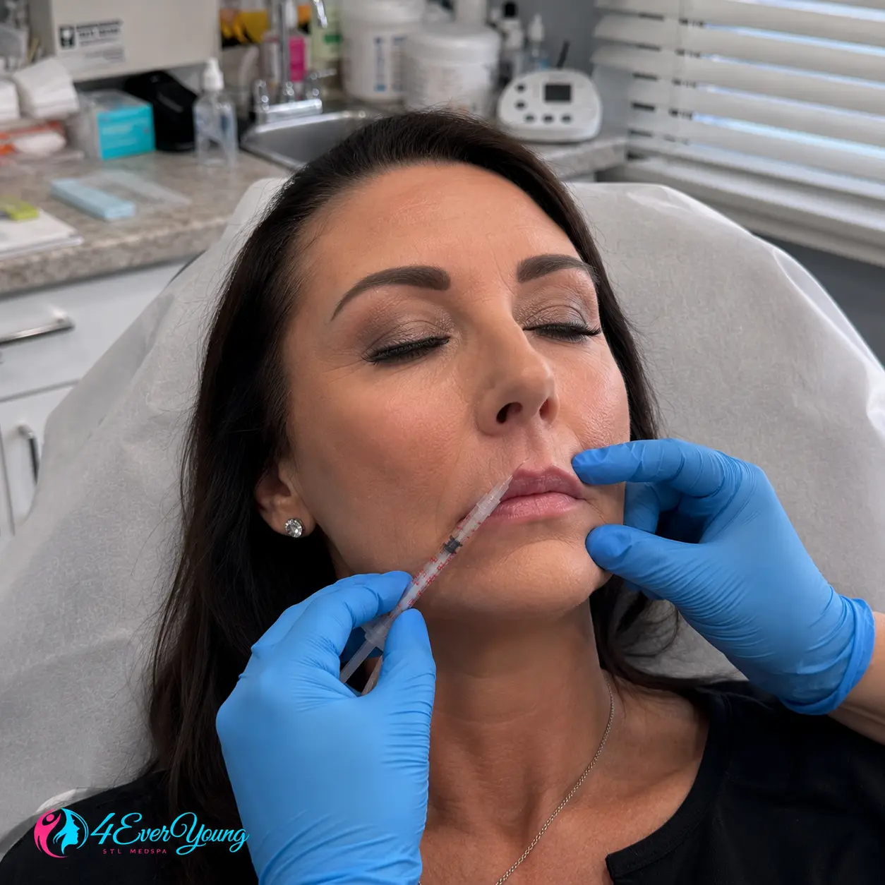 wrinkled lips treatment in creve coeur mo