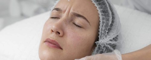 Vi Peel & Microneedling Treatment