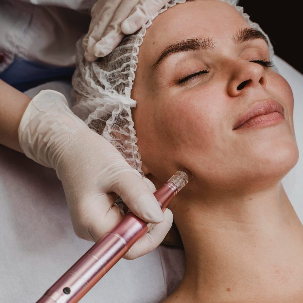 woman done microneedling in st louis